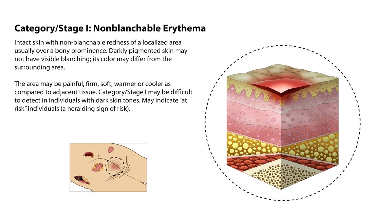 Types of Bedsores - Stage 1