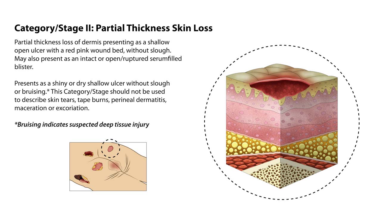 Types of Bedsores - Stage 2