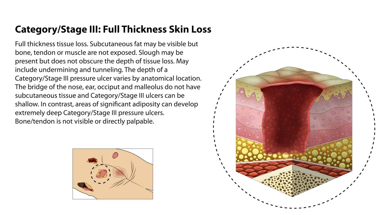 Types of Bedsores - Stage 3