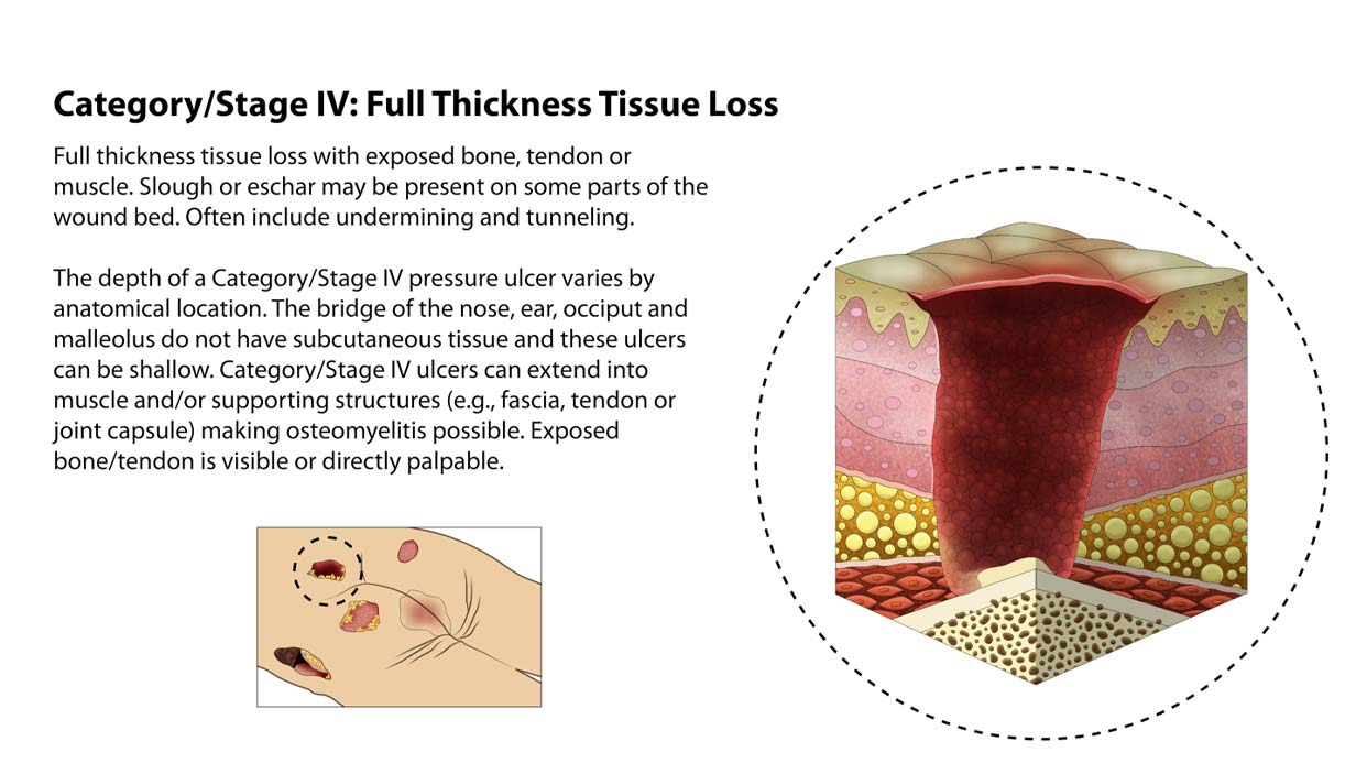 Types of Bedsores - Stage 4