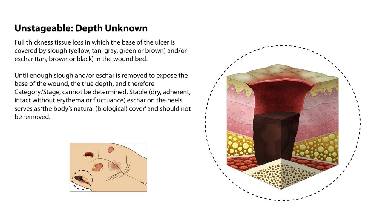 Types of Bedsores - Stage 5