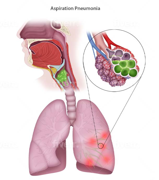 Aspiration Pneumonia